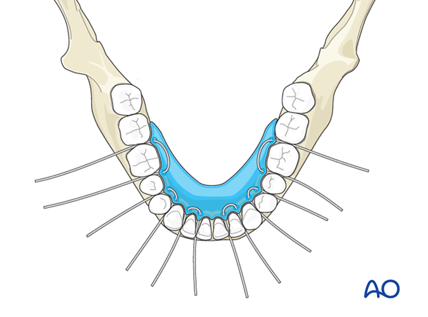 panfacial fractures sequencing of repair