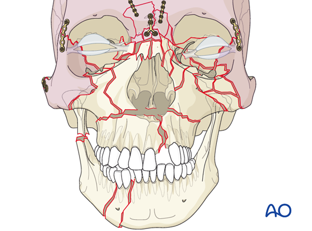 panfacial fractures sequencing of repair