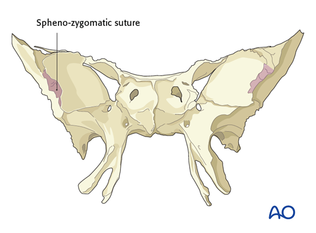 periorbital dissection of lateral orbital wall