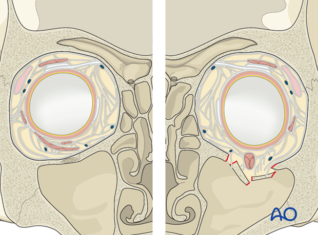 periorbital dissection introduction