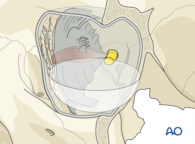 periorbital dissection introduction