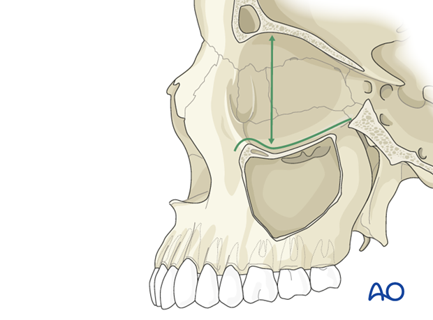 bony anatomy of the orbit