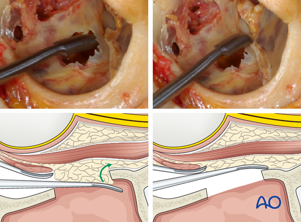 periorbital dissection of inferior orbital wall orbital floor