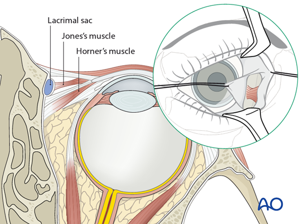 periorbital dissection introduction