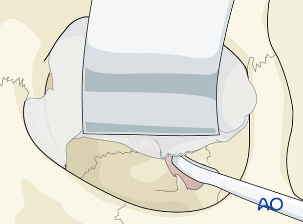 periorbital dissection of inferior orbital wall orbital floor