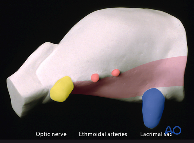 periorbital dissection of medial wall