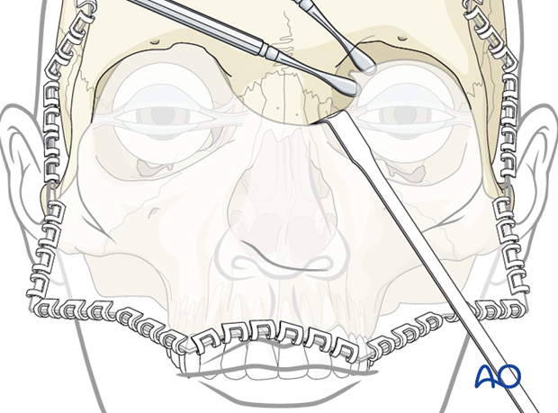 periorbital dissection of medial wall