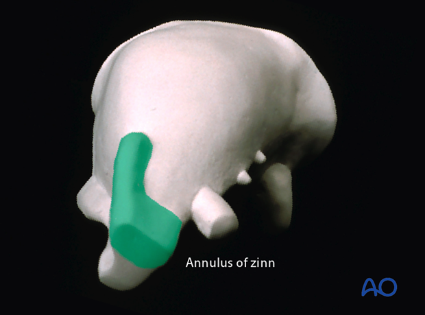 periorbital dissection of lateral orbital wall