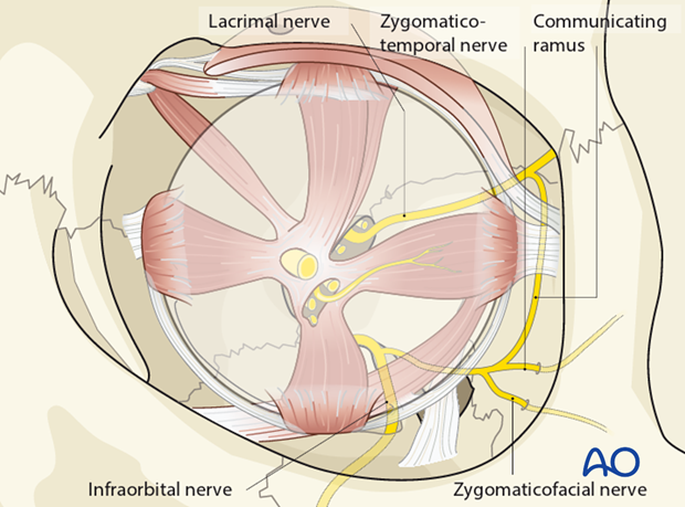 periorbital dissection of lateral orbital wall