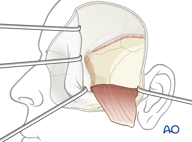 adjunctive access procedures orbitotomies