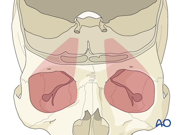 periorbital dissection of orbital roof