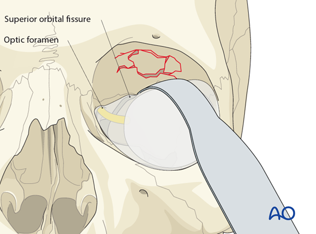 periorbital dissection of orbital roof