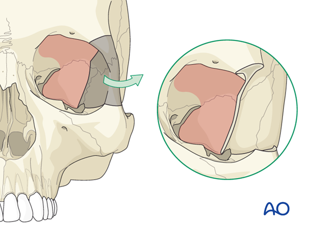 adjunctive access procedures orbitotomies