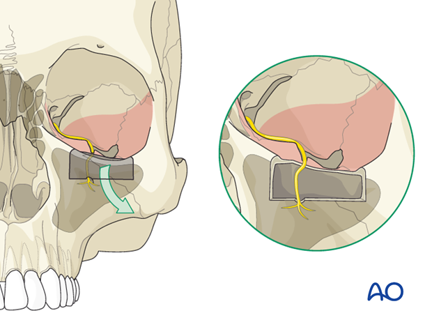 adjunctive access procedures orbitotomies