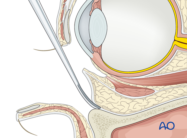 periorbital dissection of inferior orbital wall orbital floor