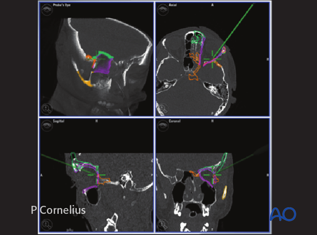 preoperative considerations