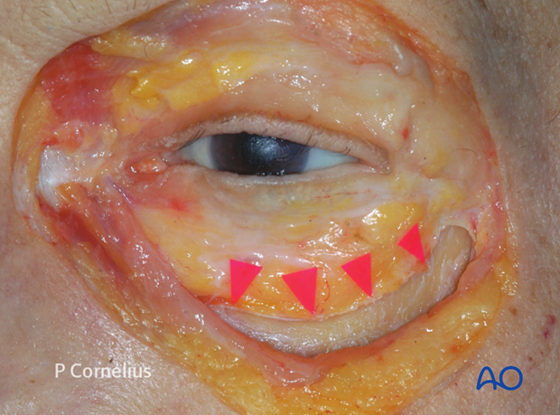 periorbital dissection of inferior orbital wall orbital floor