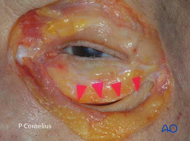 periorbital dissection of inferior orbital wall orbital floor