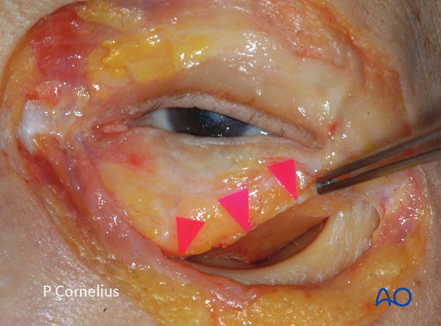 periorbital dissection of inferior orbital wall orbital floor