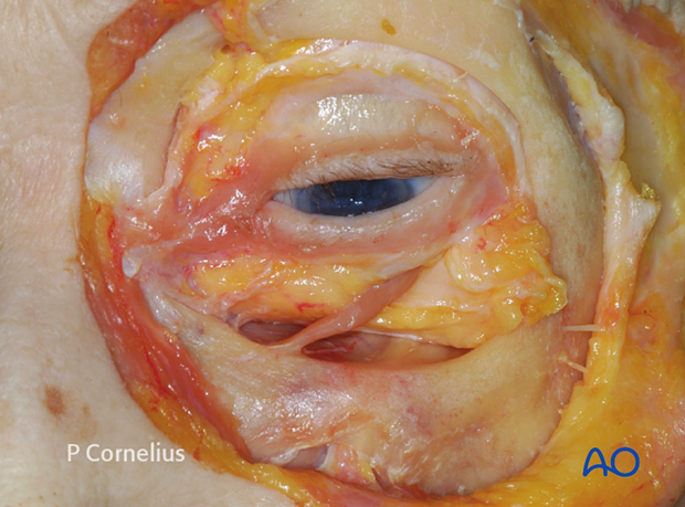 periorbital dissection of inferior orbital wall orbital floor