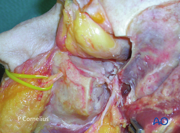 periorbital dissection of inferior orbital wall orbital floor