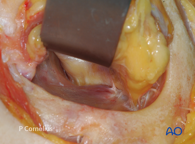 periorbital dissection of inferior orbital wall orbital floor