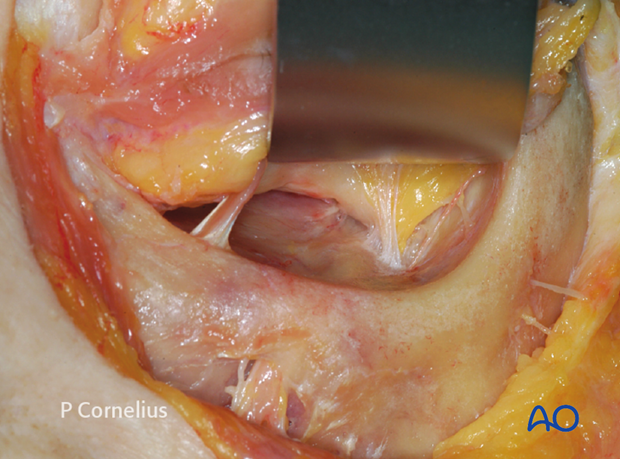 periorbital dissection of inferior orbital wall orbital floor