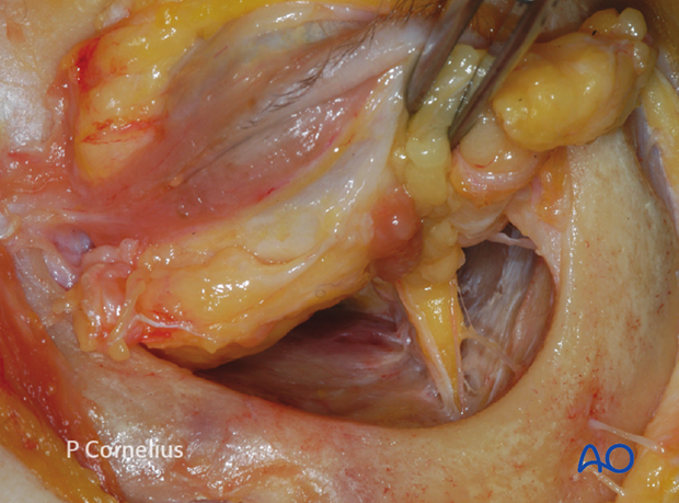 periorbital dissection of inferior orbital wall orbital floor