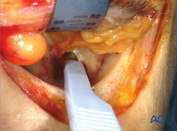 periorbital dissection of inferior orbital wall orbital floor