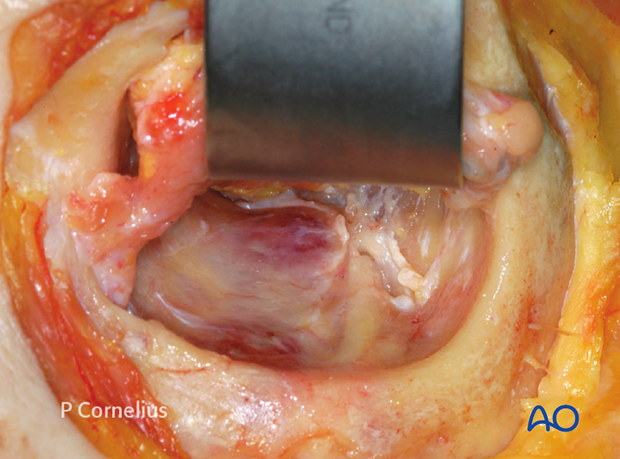 periorbital dissection of inferior orbital wall orbital floor