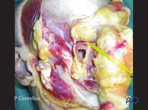 periorbital dissection of inferior orbital wall orbital floor