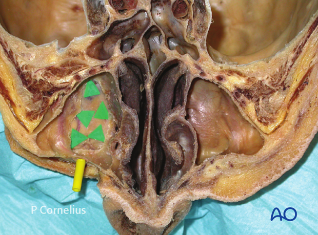 periorbital dissection of inferior orbital wall orbital floor