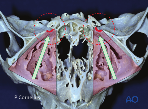 periorbital dissection of inferior orbital wall orbital floor