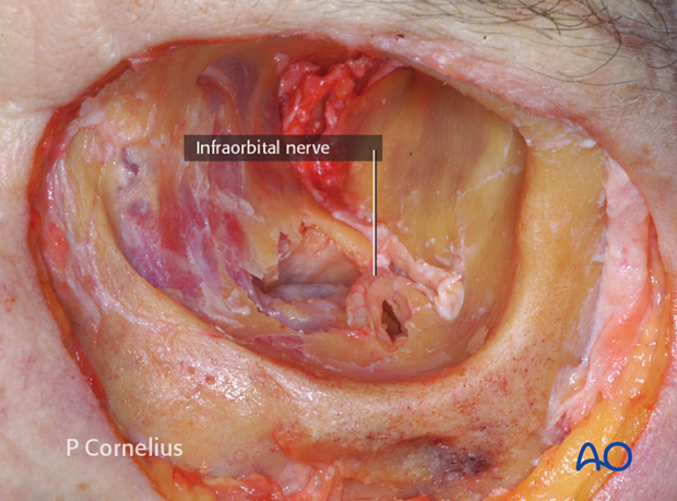 periorbital dissection of inferior orbital wall orbital floor