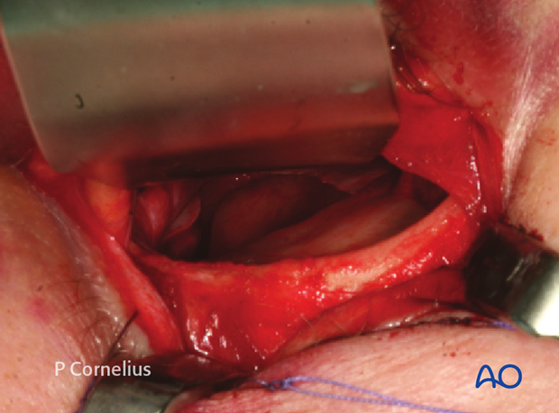 periorbital dissection of inferior orbital wall orbital floor