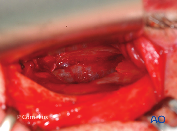 periorbital dissection of inferior orbital wall orbital floor