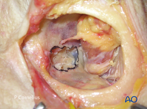 periorbital dissection of medial wall