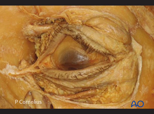 periorbital dissection of medial wall