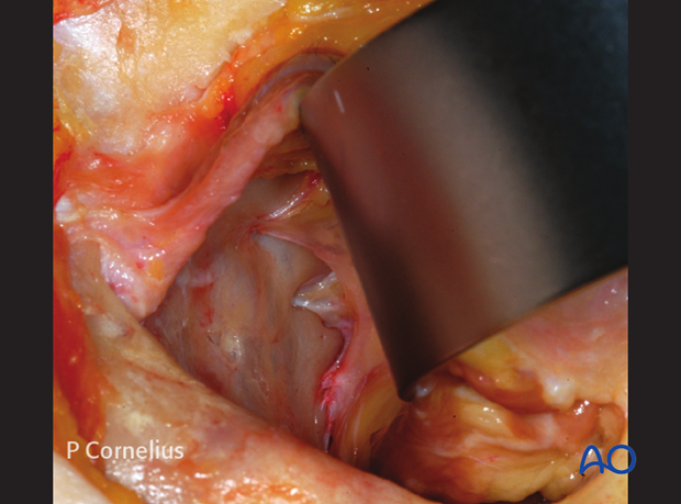 periorbital dissection of medial wall