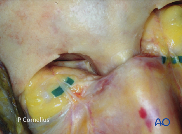 periorbital dissection of medial wall