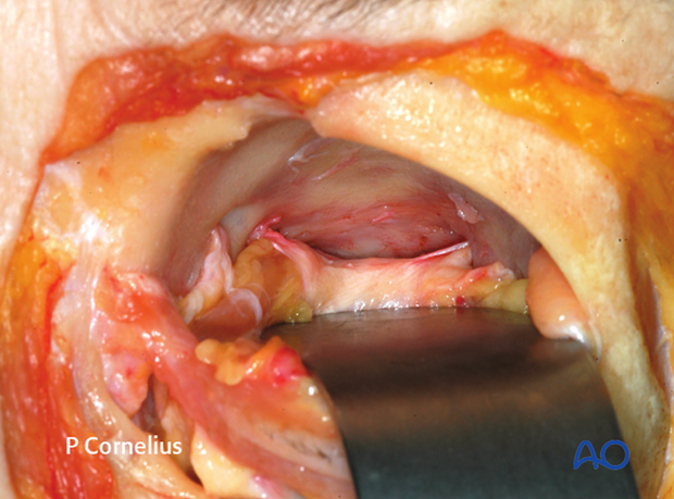 periorbital dissection of medial wall