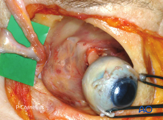 periorbital dissection of medial wall