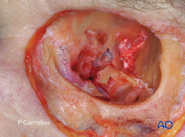 periorbital dissection of medial wall