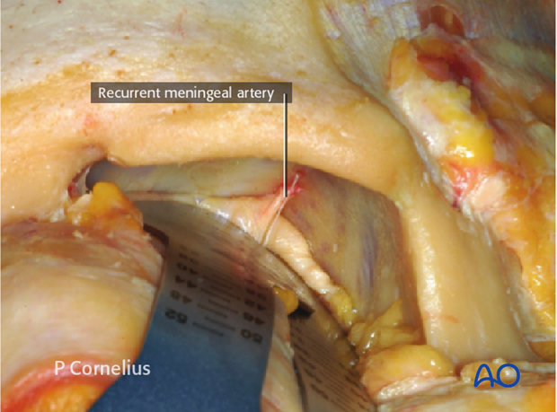 periorbital dissection of lateral orbital wall