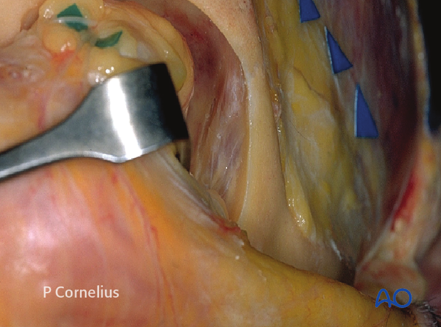 periorbital dissection of lateral orbital wall