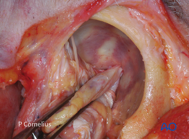 periorbital dissection of lateral orbital wall