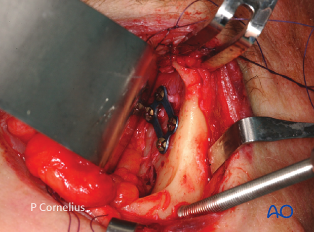 periorbital dissection of lateral orbital wall