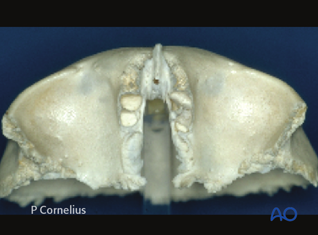 periorbital dissection of orbital roof