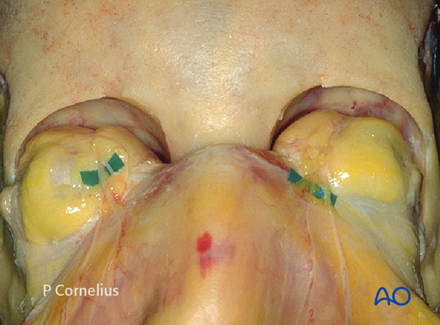 periorbital dissection of orbital roof