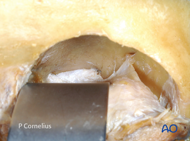 periorbital dissection of orbital roof